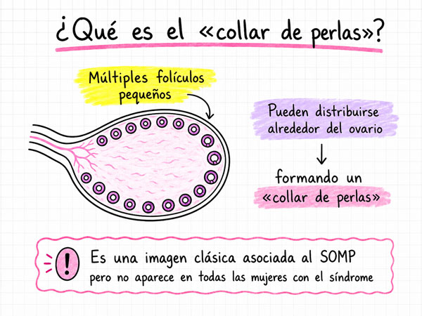 Collar de perlas folículo ovárico