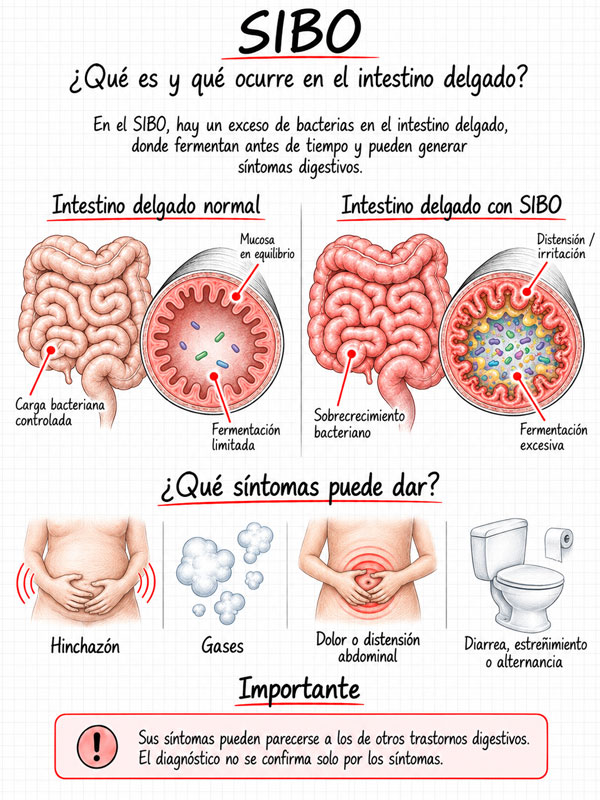 Infografía médica sobre qué es el SIBO, con sobrecrecimiento bacteriano en el intestino delgado y sus principales efectos digestivos