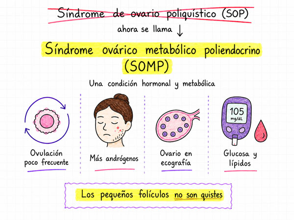 SOMP síndrome ovario metabólico Poliendocrino