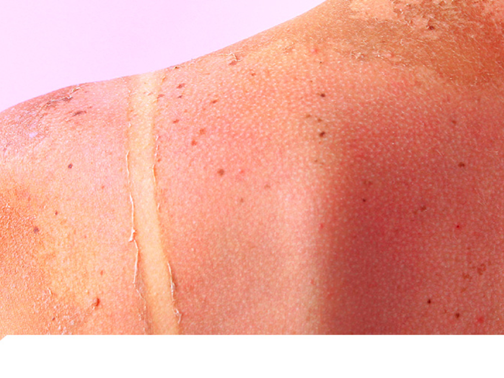 Beneficios del Betacaroteno manchas y quemaduras