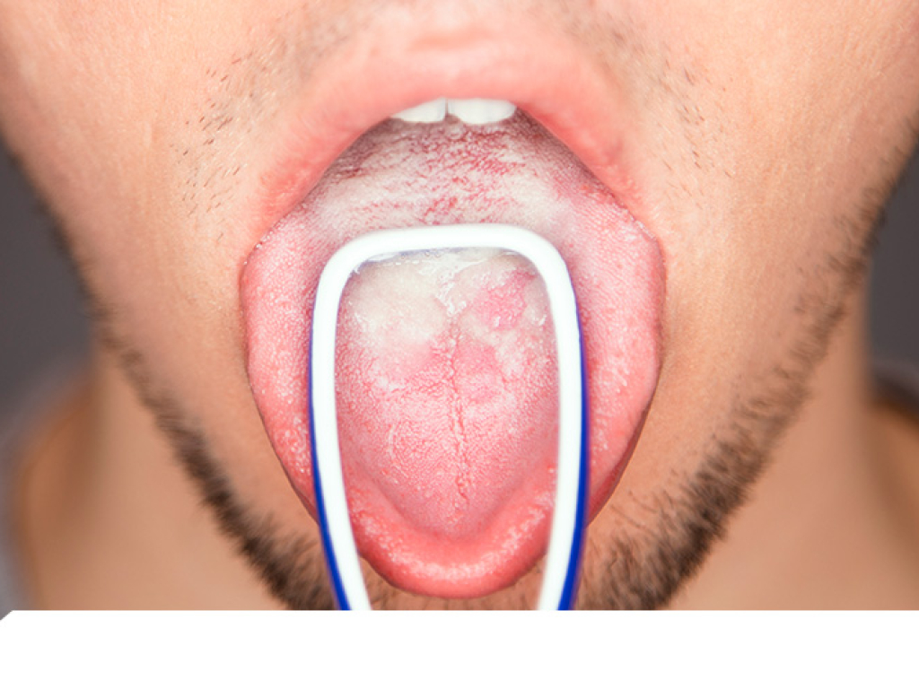 Candidiasis en lengua