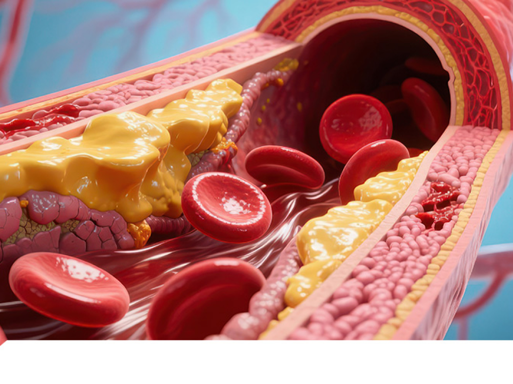 Lipoproteina(a)