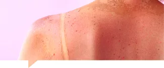 Beneficios del Betacaroteno manchas y quemaduras