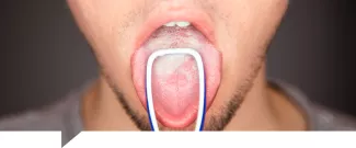 Candidiasis en lengua
